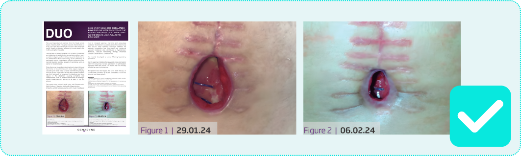 DUO Genadyne Instill