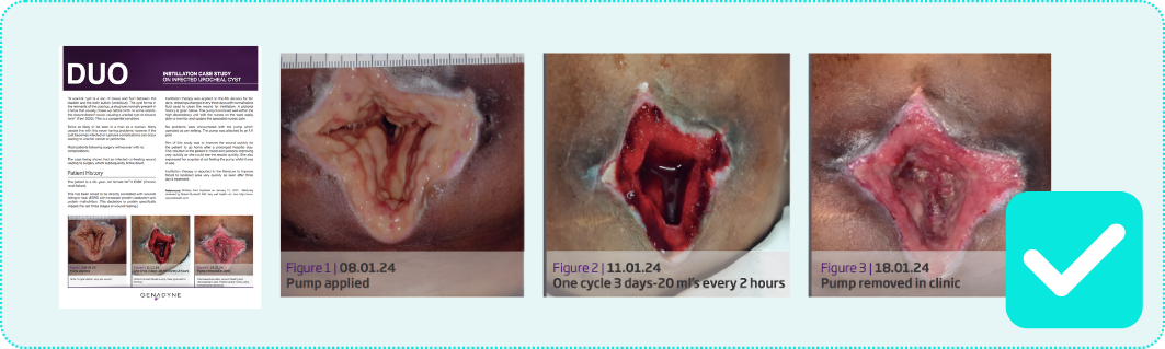 DUO Genadyne NPWT and Instill