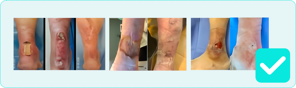 Effective Management of Venous Leg Ulcers by Copper Dressings Results